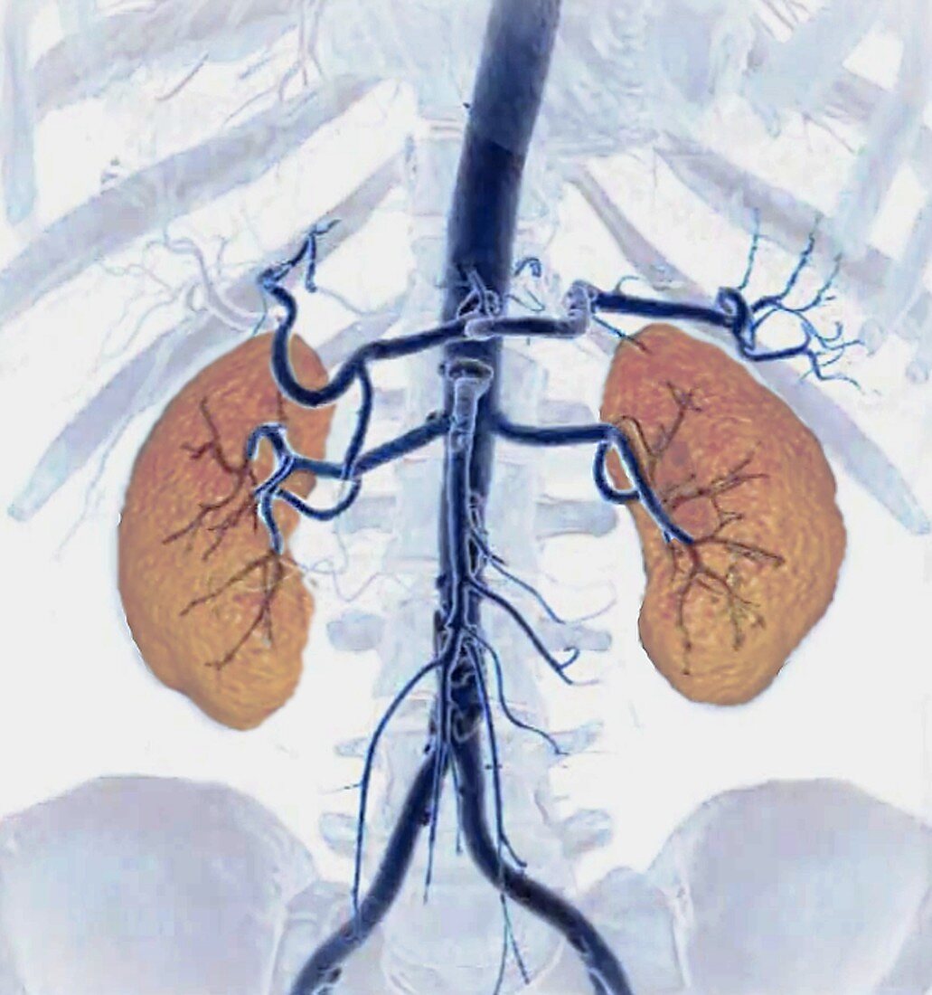 Healthy kidneys, CT scan