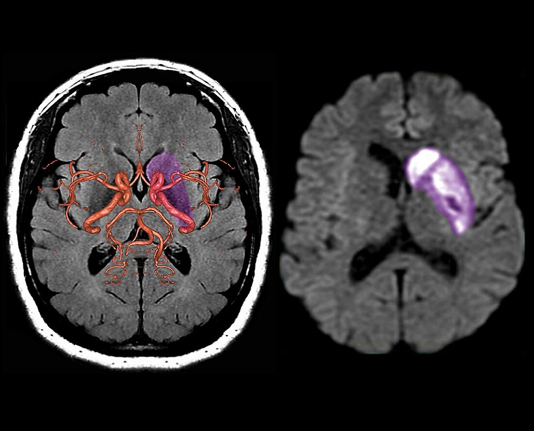 Stroke, MRI scans