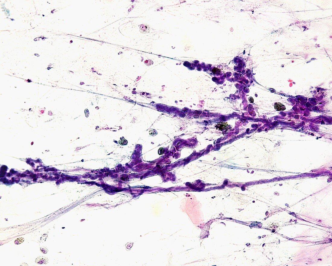 Curschmann spiral in sputum smear, light micrograph