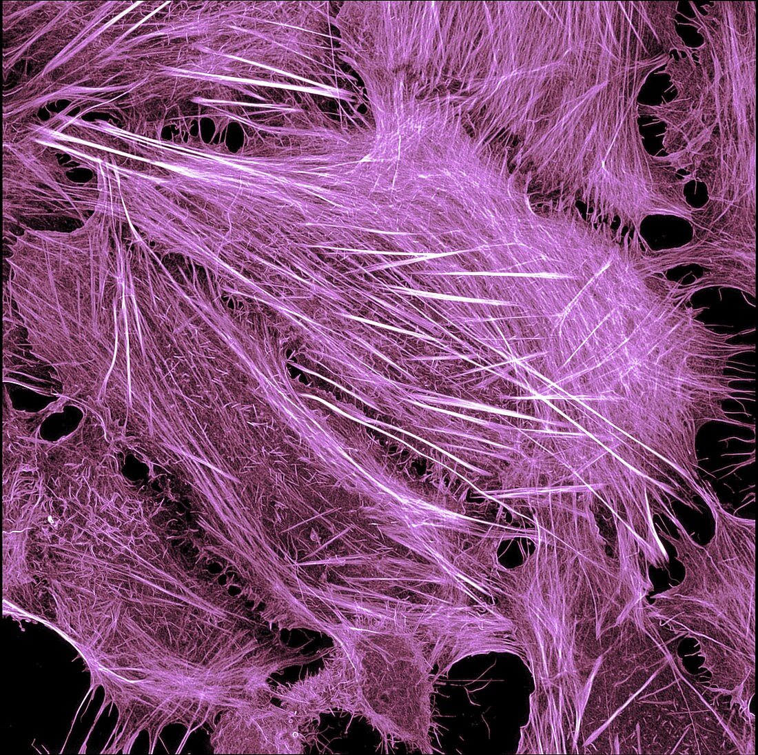 Cancer cell showing actin cytoskeleton, light micrograph