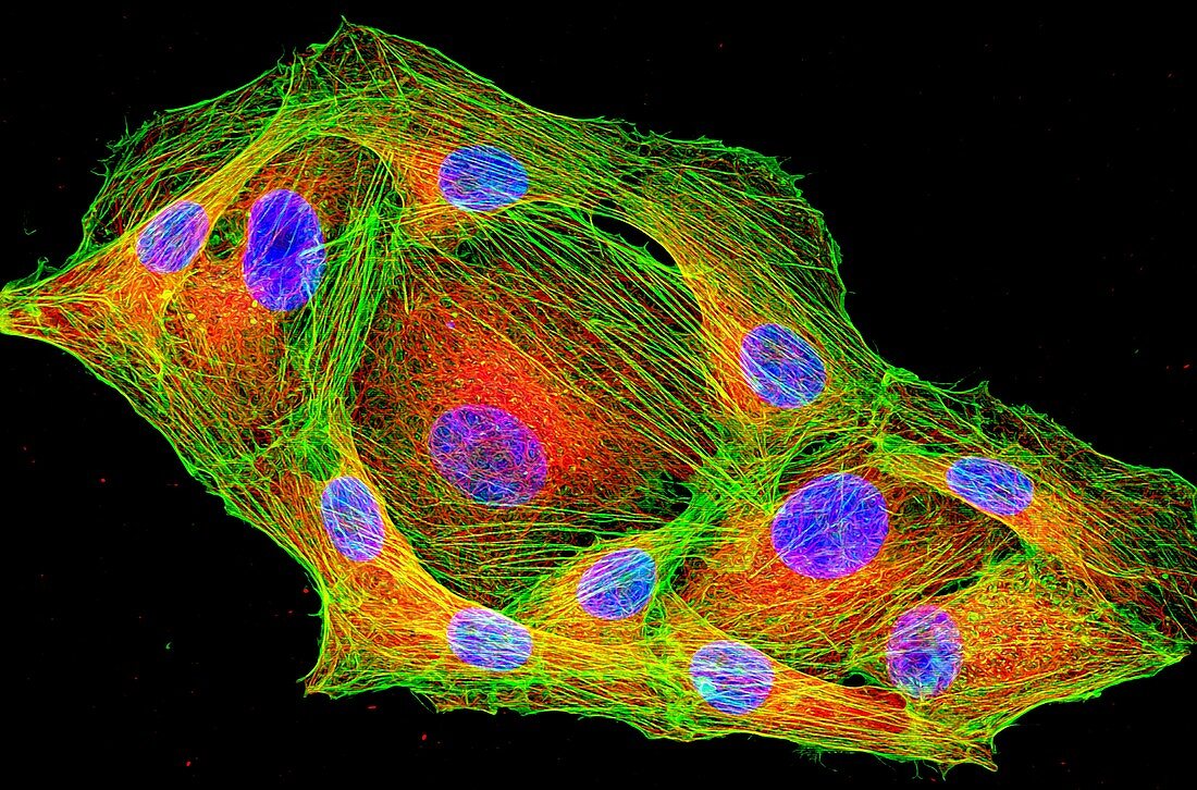 Cancer cells cytoskeleton and nuclei, light micrograph
