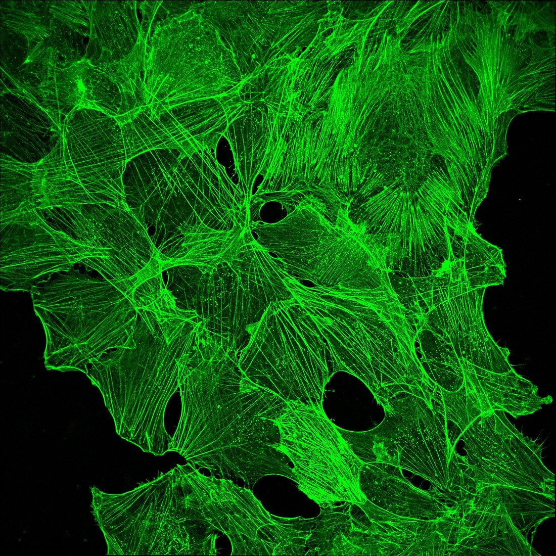 Cancer cells green, light micrograph