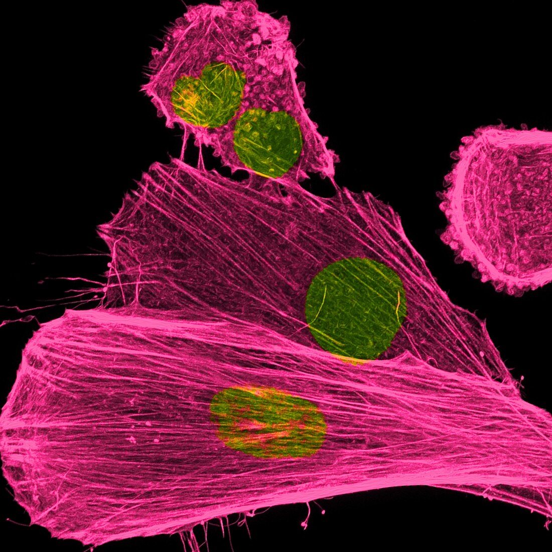 Cancer cells nuclei and cytoskeleton, light micrograph