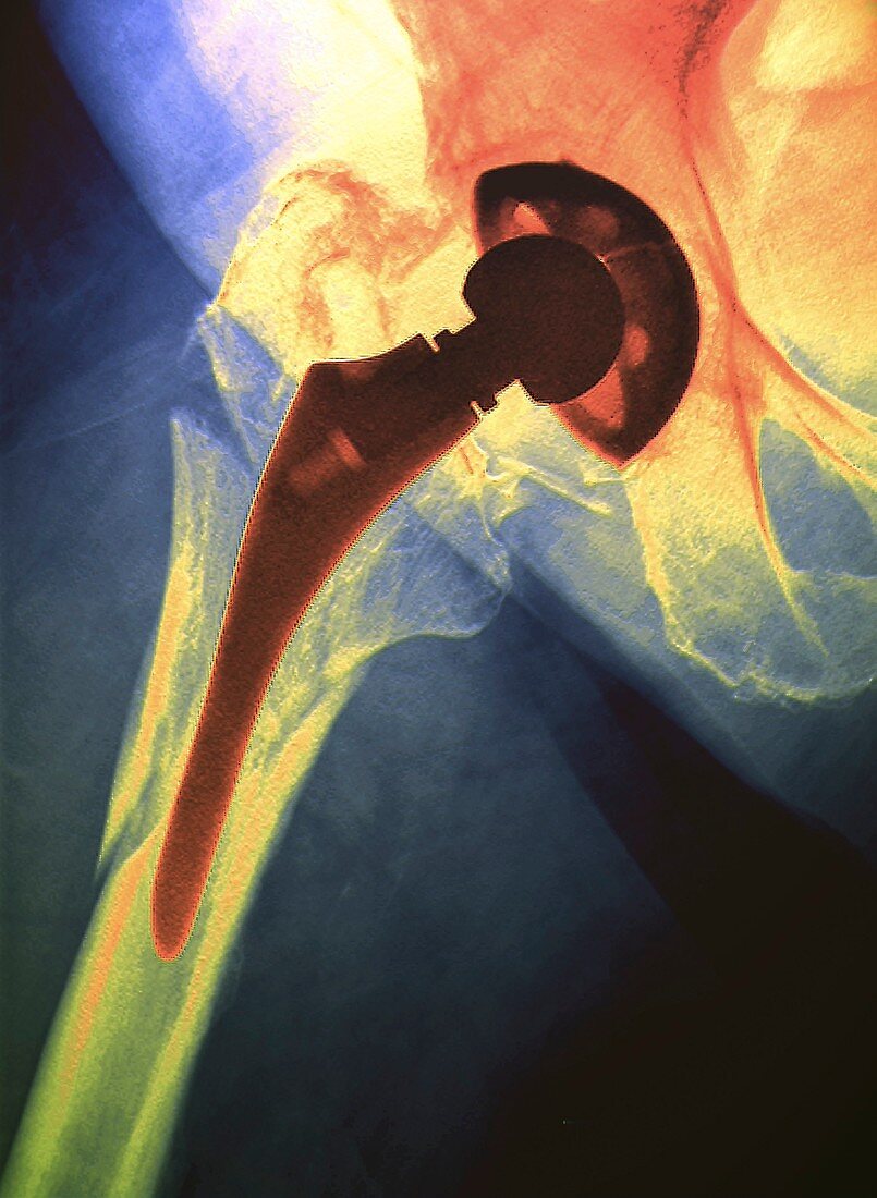 Fractured thigh bone, X-ray