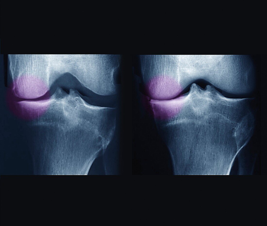 Knee osteoarthritis, X-rays