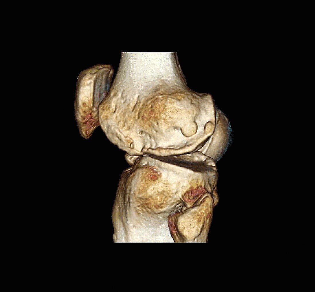 Healthy knee, CT scan