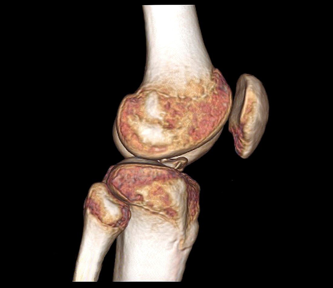 Healthy knee, CT scan
