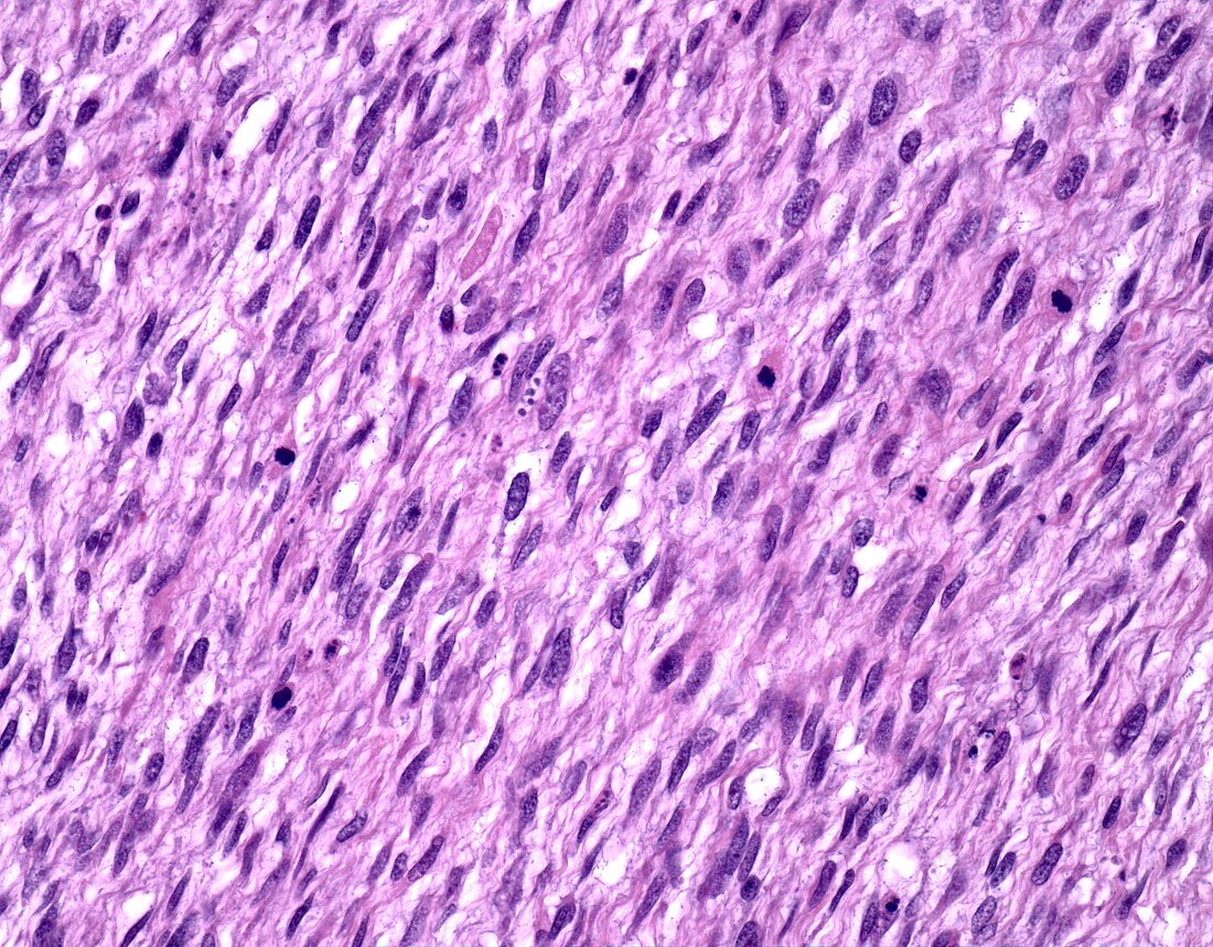 Spindle cell rhabdomyosarcoma, light micrograph