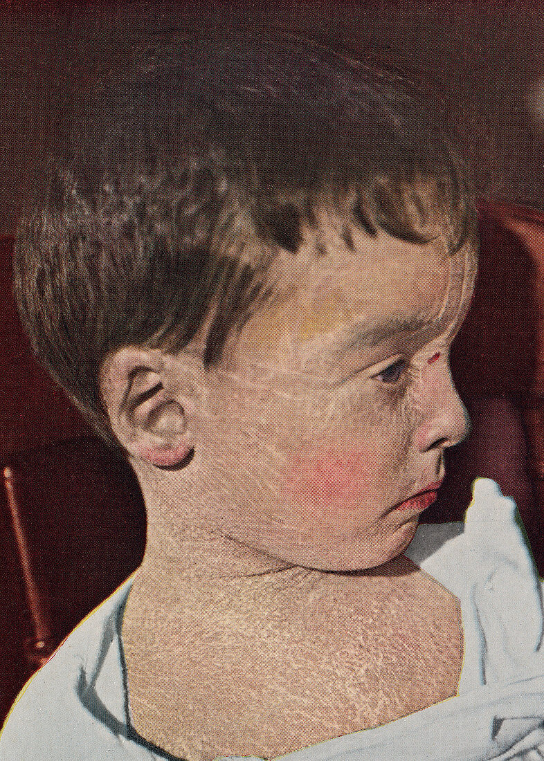 Boy with ichthyosis, historical image