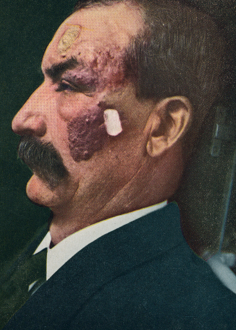 Port-wine stain, historical image