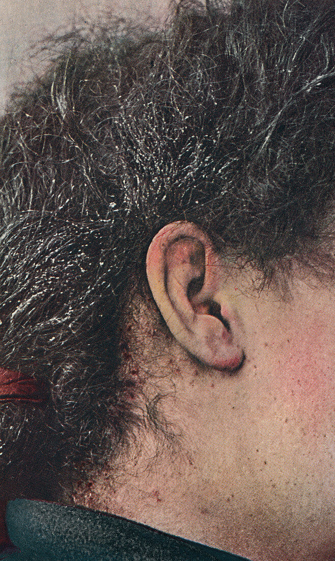 Head lice, historical image