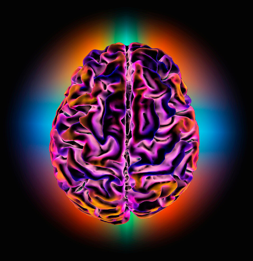 Alzheimer's disease, 3D MRI scan