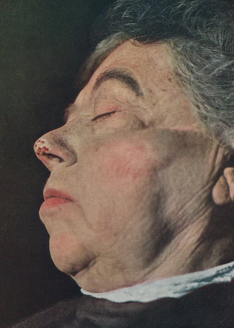 Epithelioma, historical image