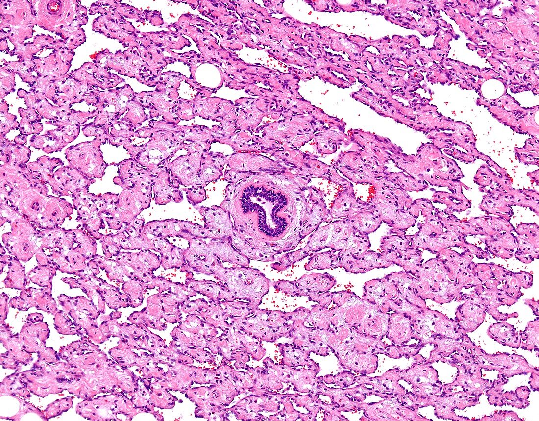 Angiosarcoma of breast, light micrograph