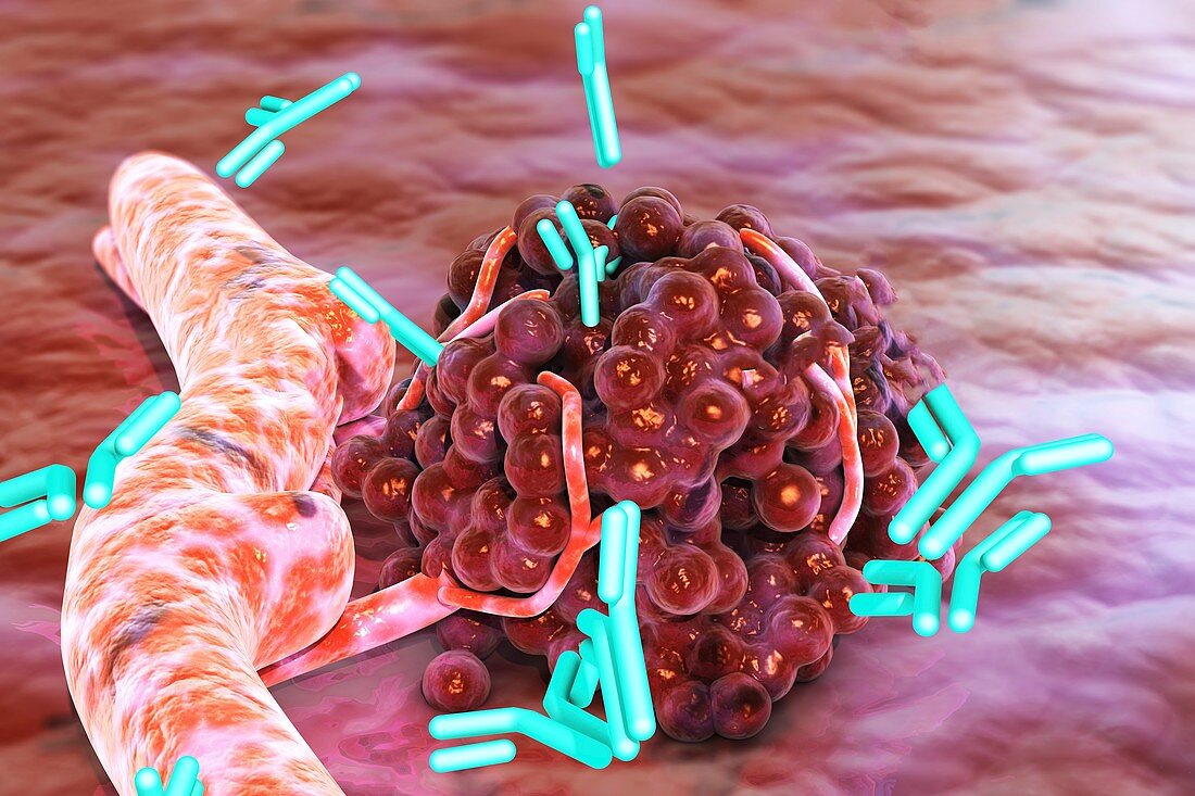 Antibodies attacking tumour, illustration