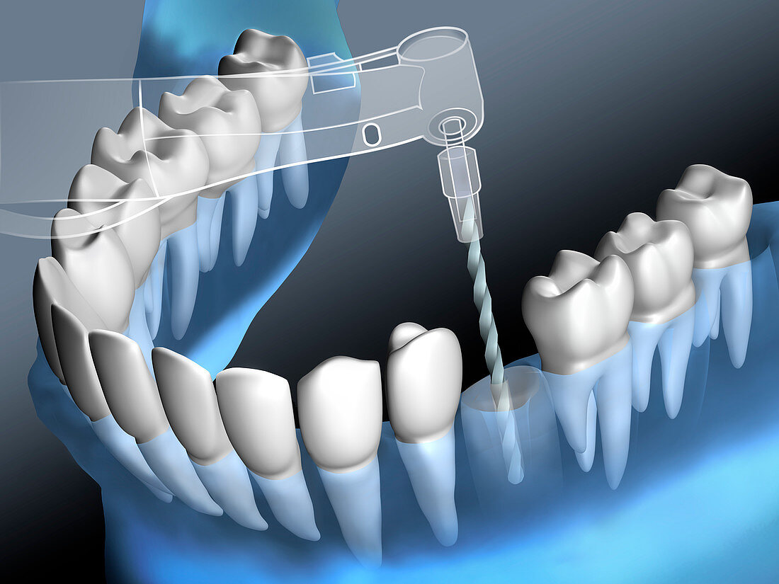 Drilling for a dental implant, illustration