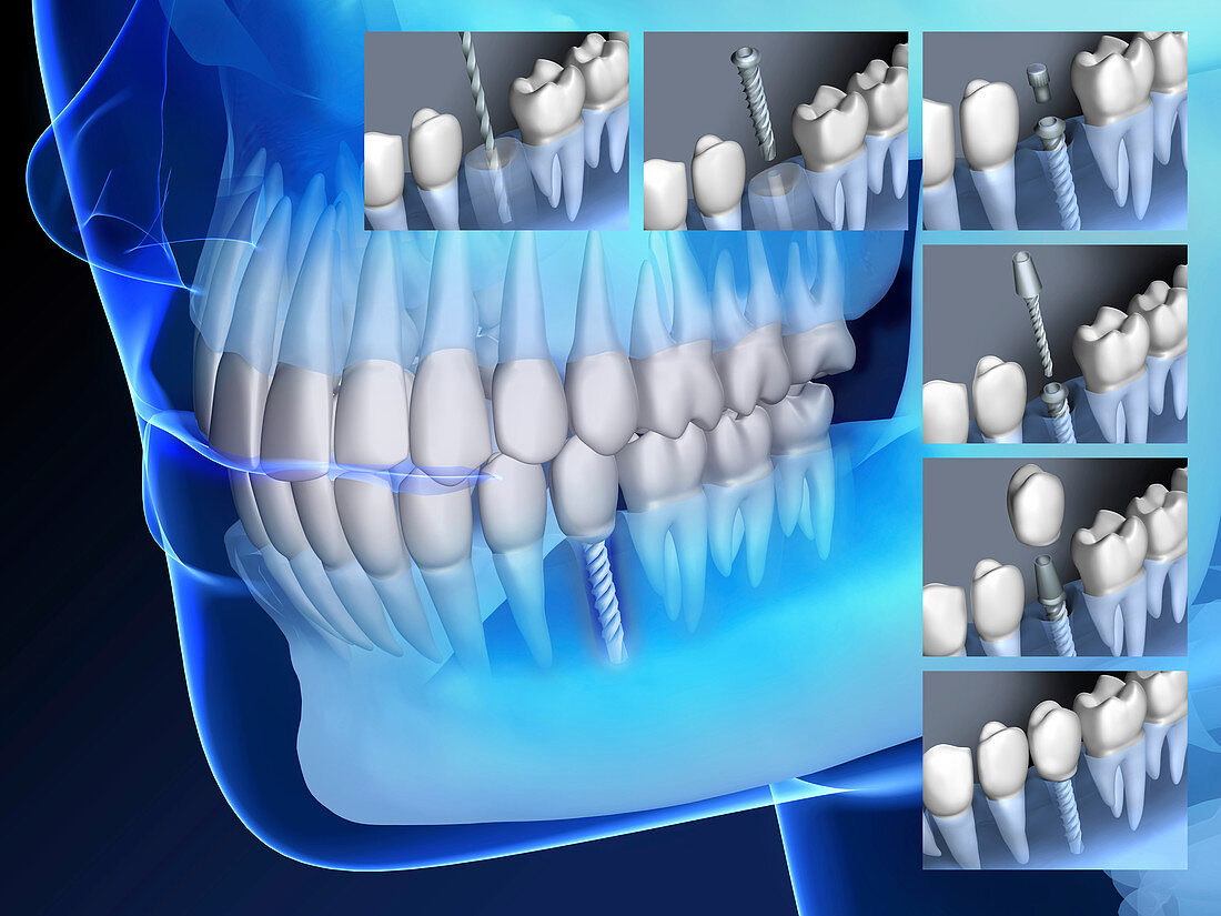 Dental implant insertion, illustration