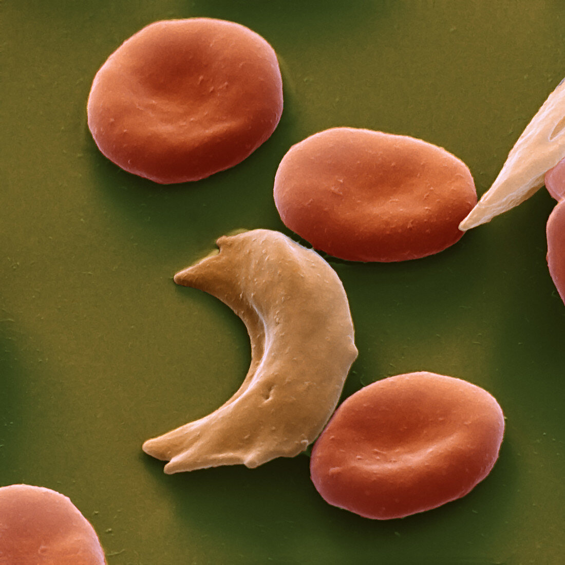 Sickle cell anaemia, SEM