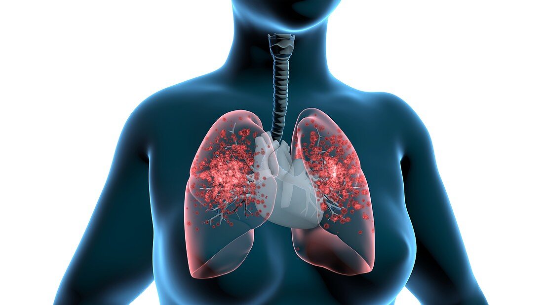 Infected lungs, 3D illustration