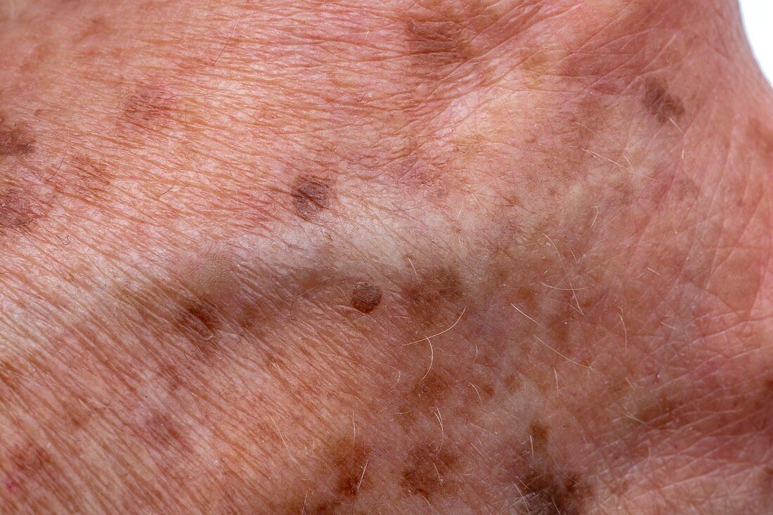 Age spots on elderly skin