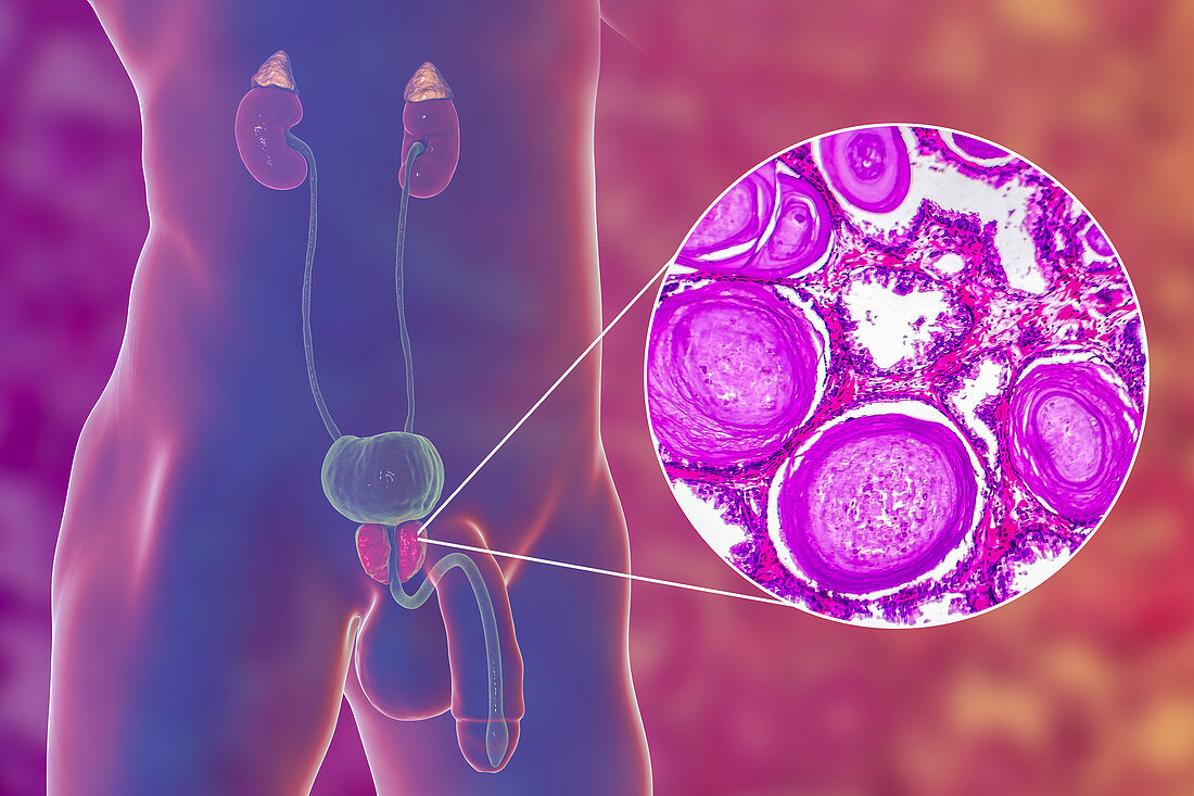 Benign prostatic hyperplasia, illustration and micrograph