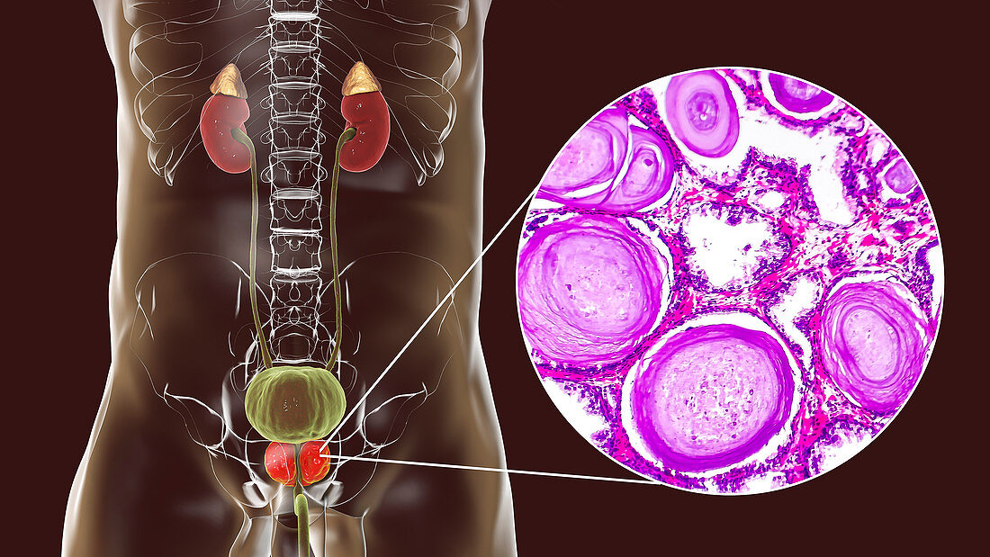 Benign prostatic hyperplasia, illustration and micrograph