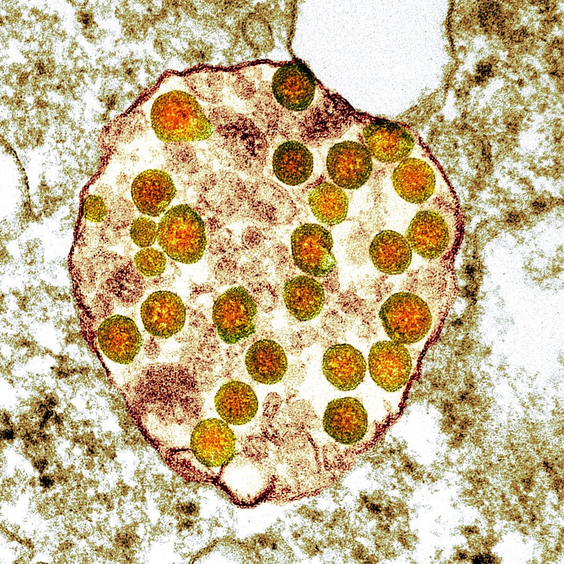 Cell infected with Covid-19 coronavirus particles, TEM