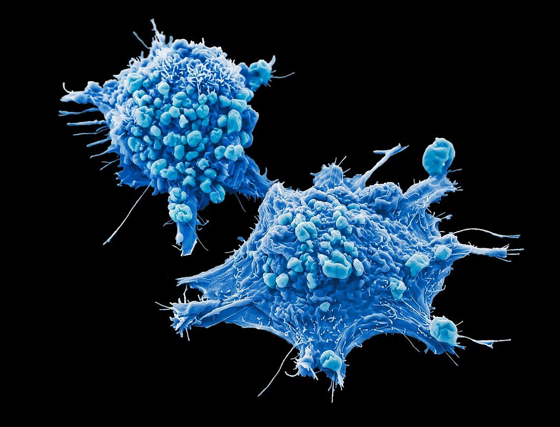 Lung cancer cells, SEM