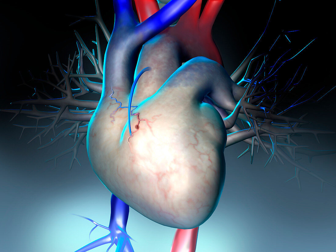 Heart bypass graft, illustration