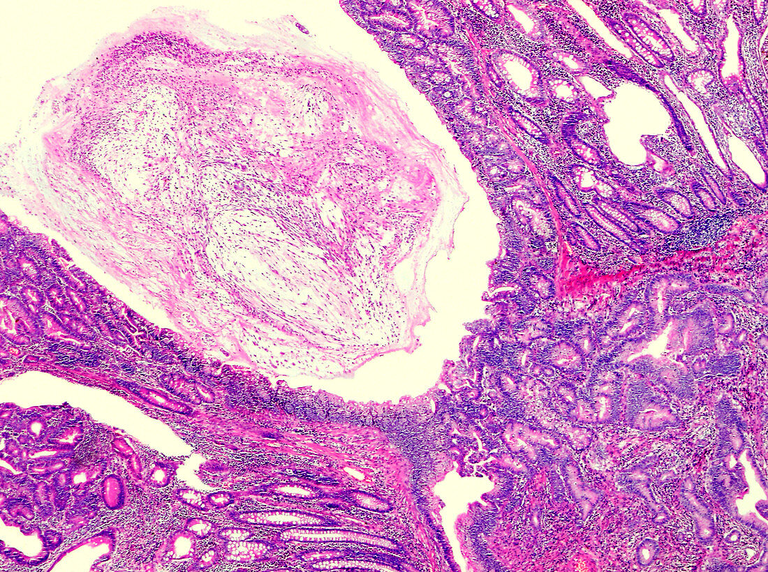 Carcinoma of the colon, light micrograph