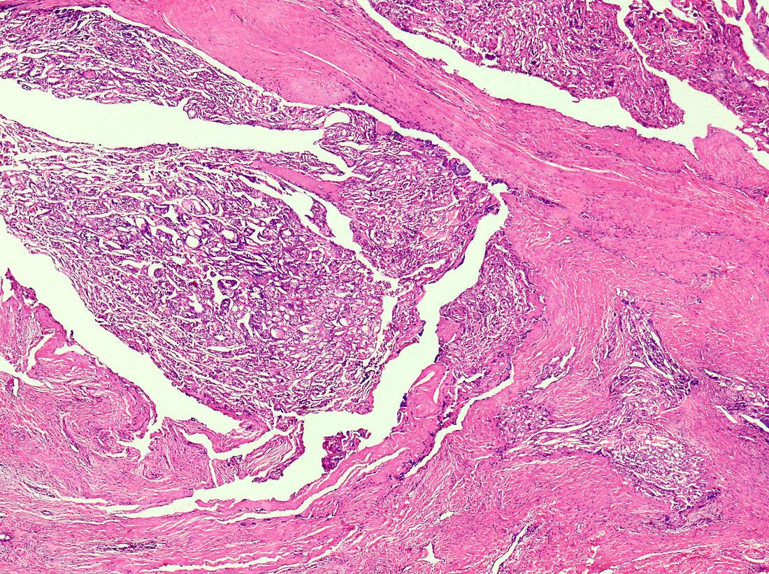Human papillary thyroid carcinoma, light micrograph