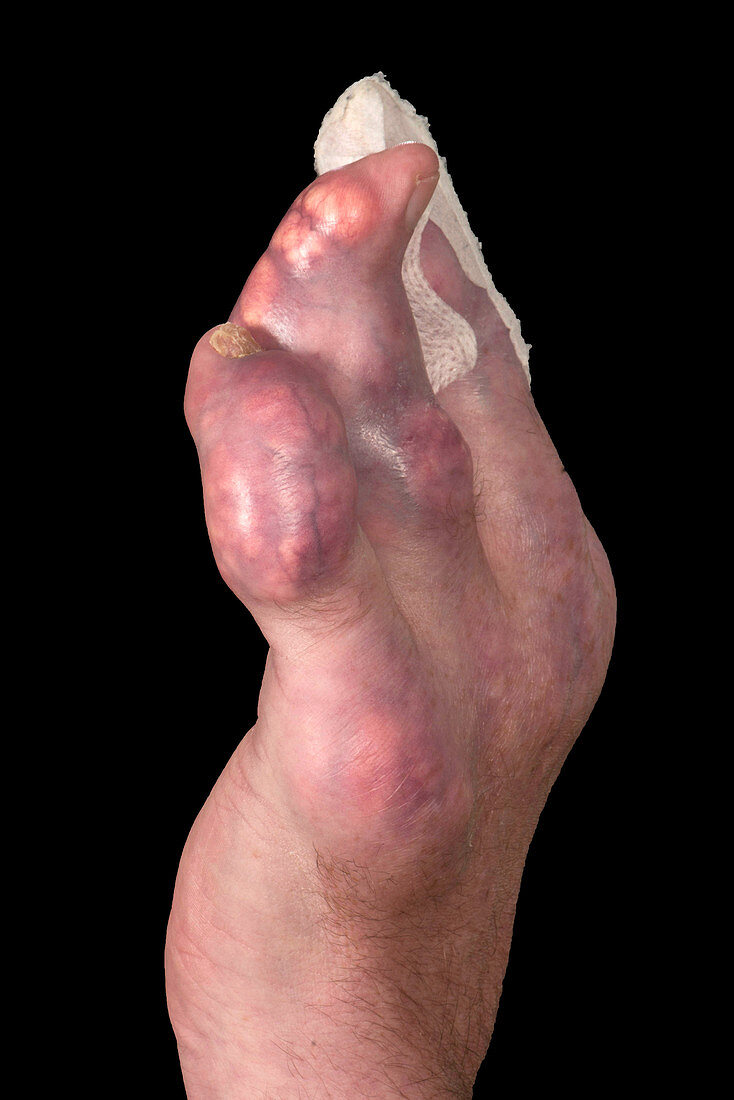 Severe gout
