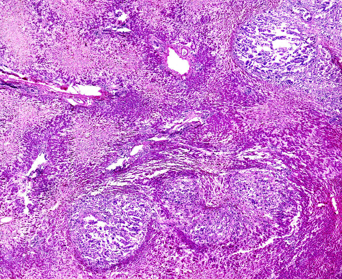 Liver adenocarcinoma, light micrograph