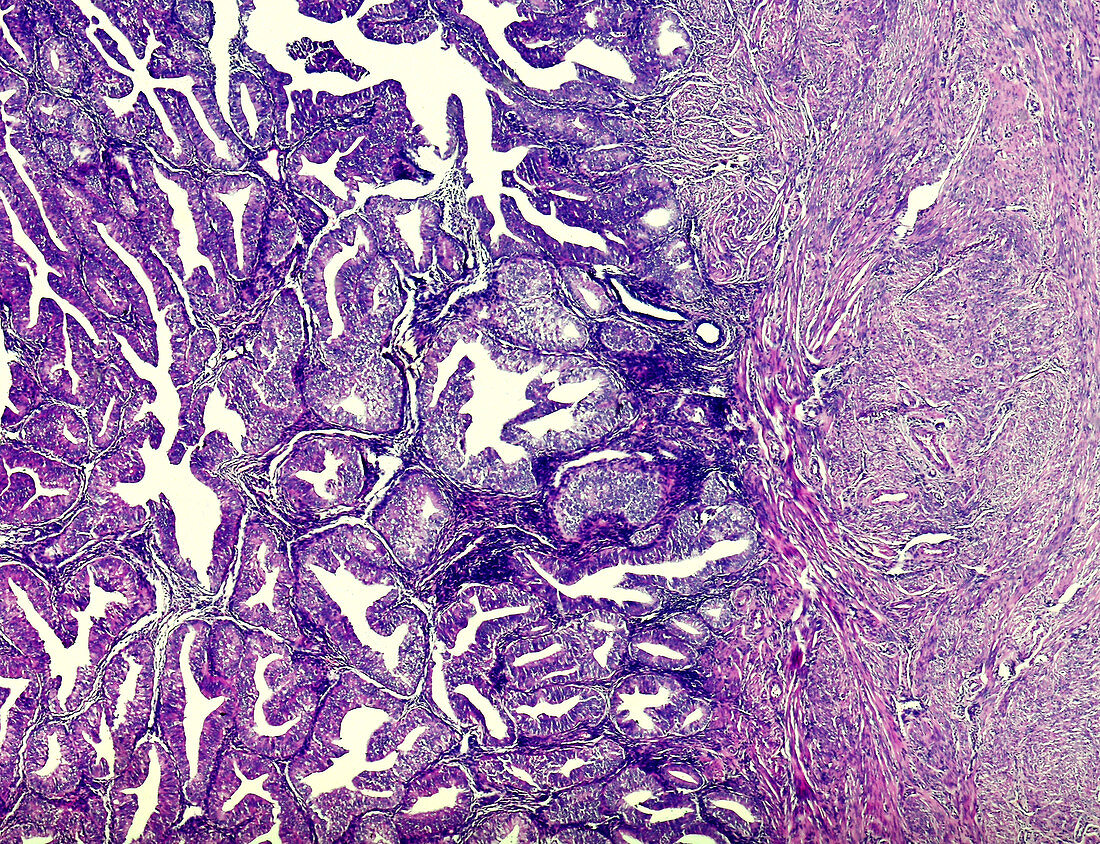 Carcinoma of the endometrium, light micrograph