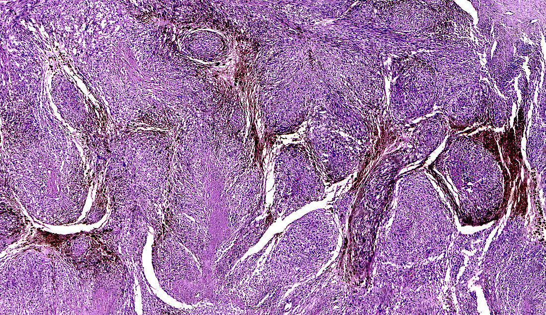 Malignant melanoma in human skin, light micrograph