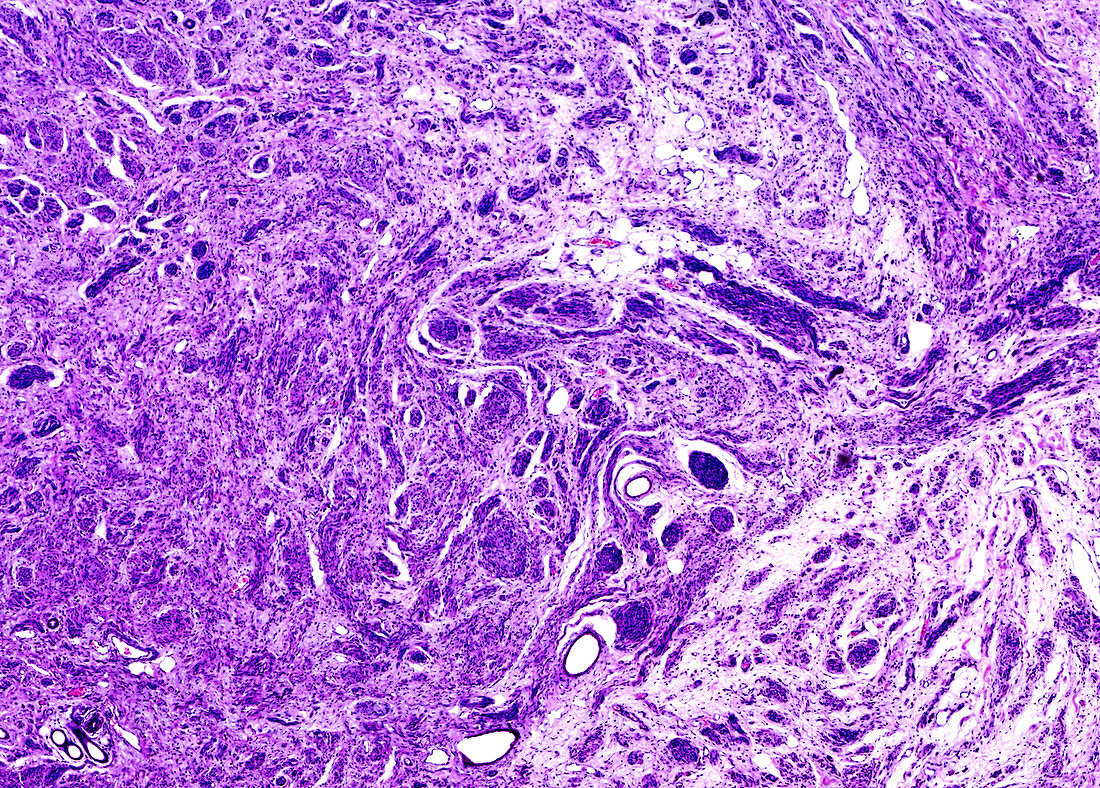 Neurofibromatosis type 2, light micrograph