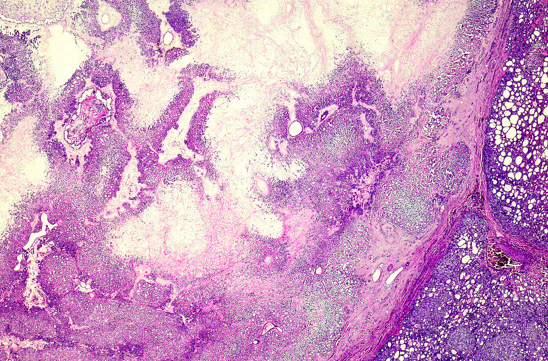 Ovarian teratoma, light micrograph