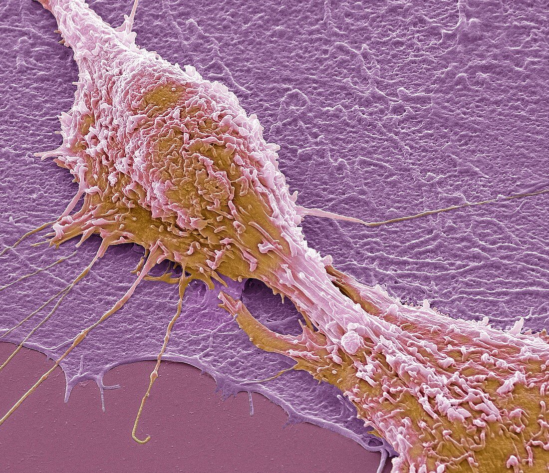 Colorectal cancer cell, SEM
