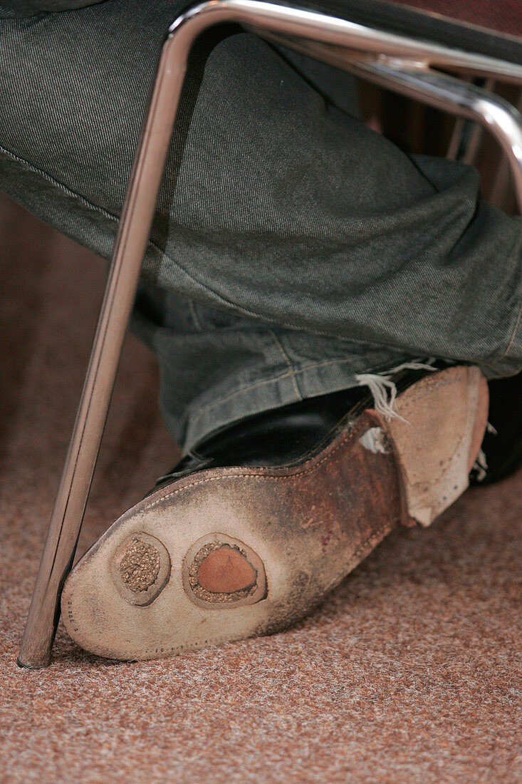 Holes in man's shoe