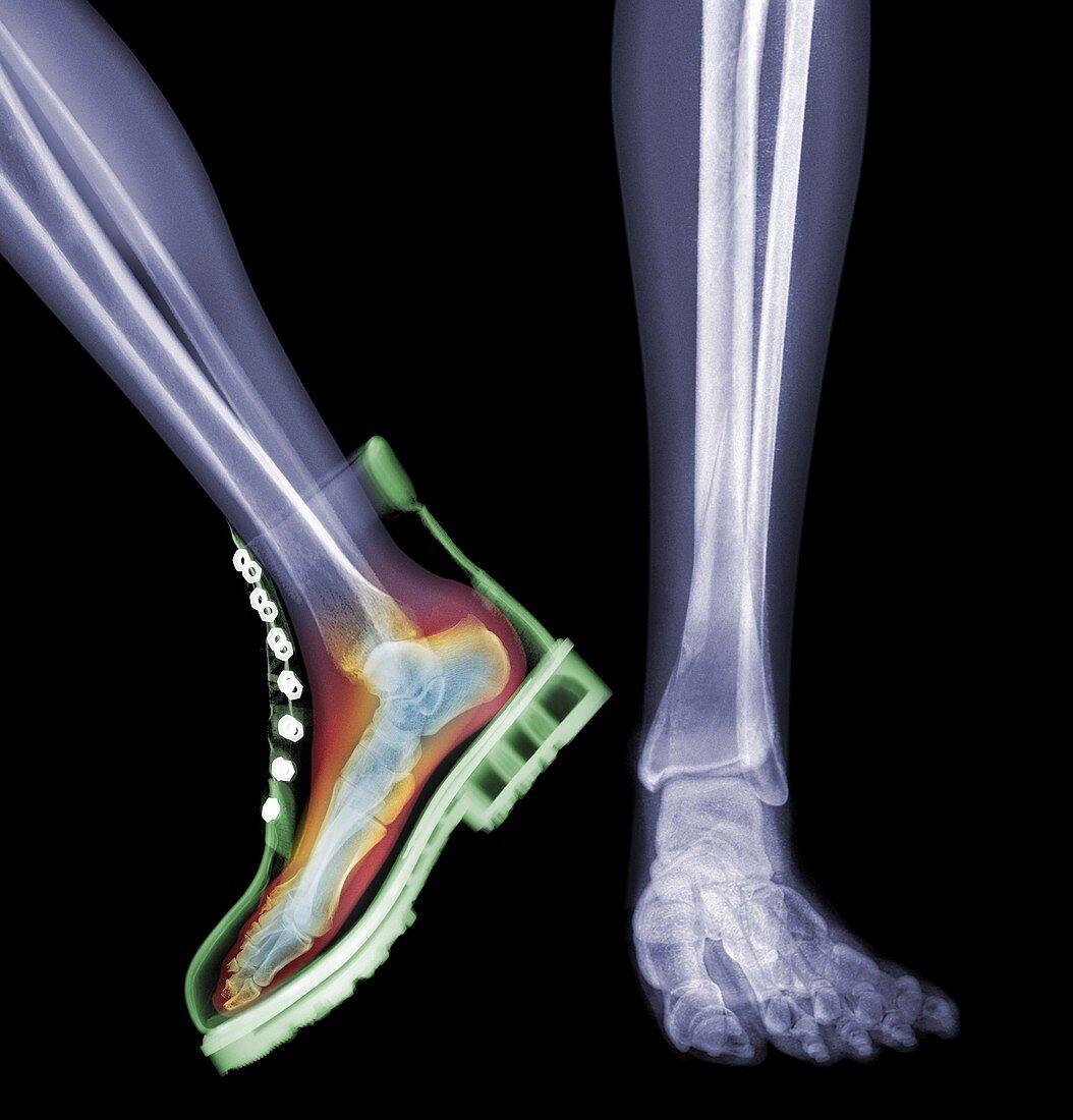 Skeleton feet with one foot in boot, X-ray