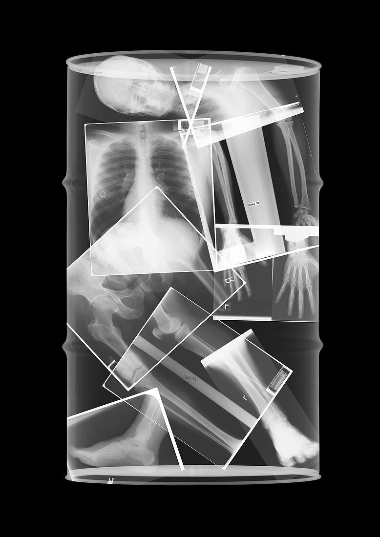 Oil drum skeleton, X-ray