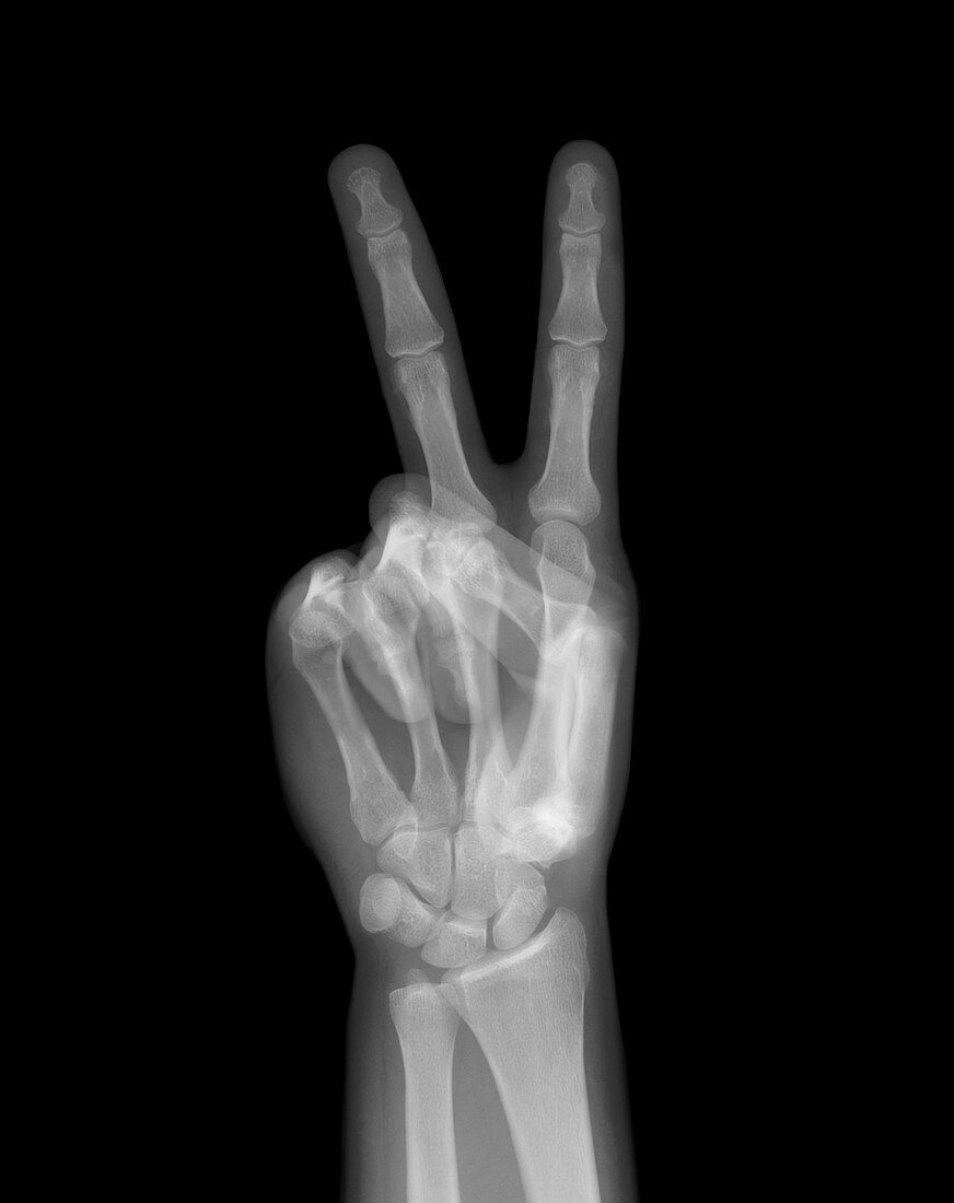 Peace hand gesture, X-ray