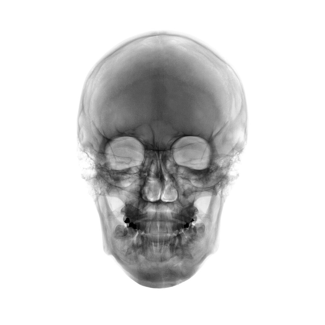 Human skull, X-ray