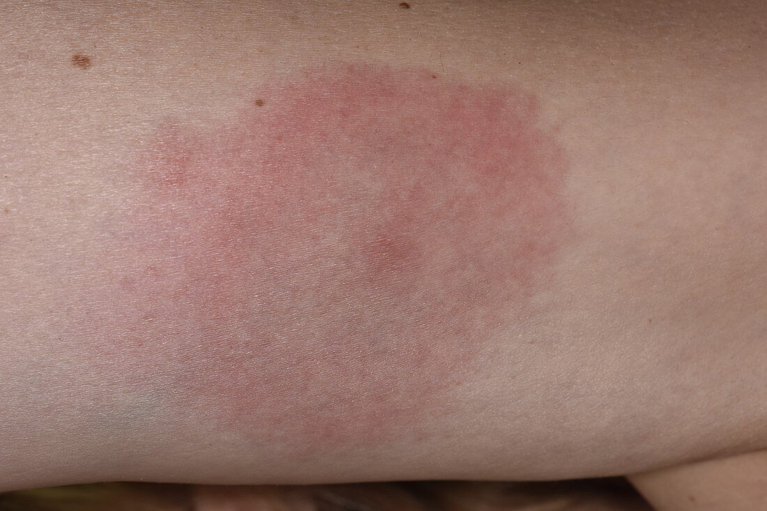 Allergic reaction to insect bite
