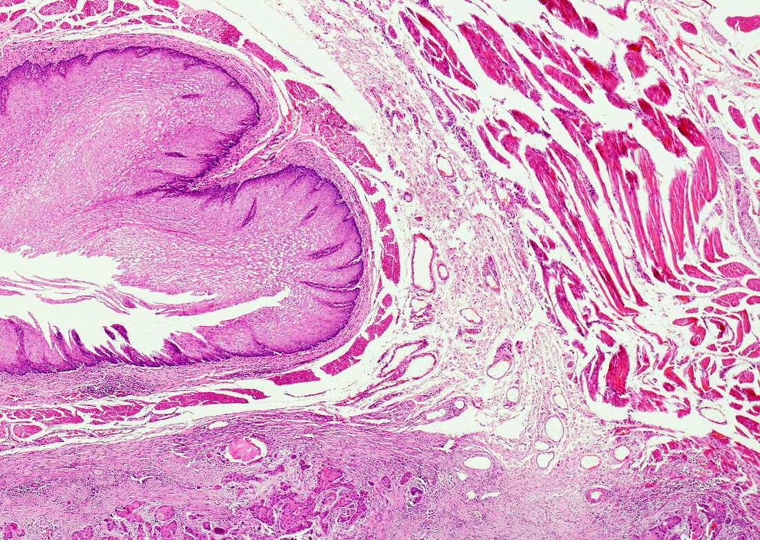 Epidermoid carcinoma of the esophagus, light micrograph