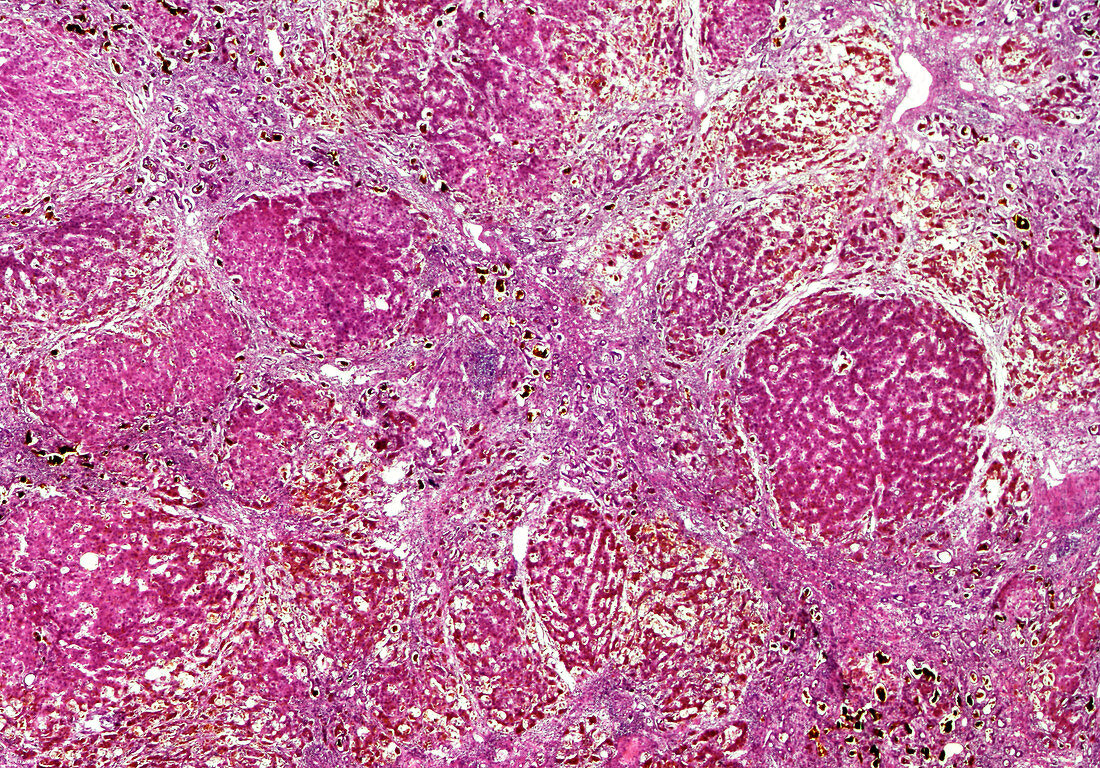 Laennec's cirrhosis of the liver, light micrograph