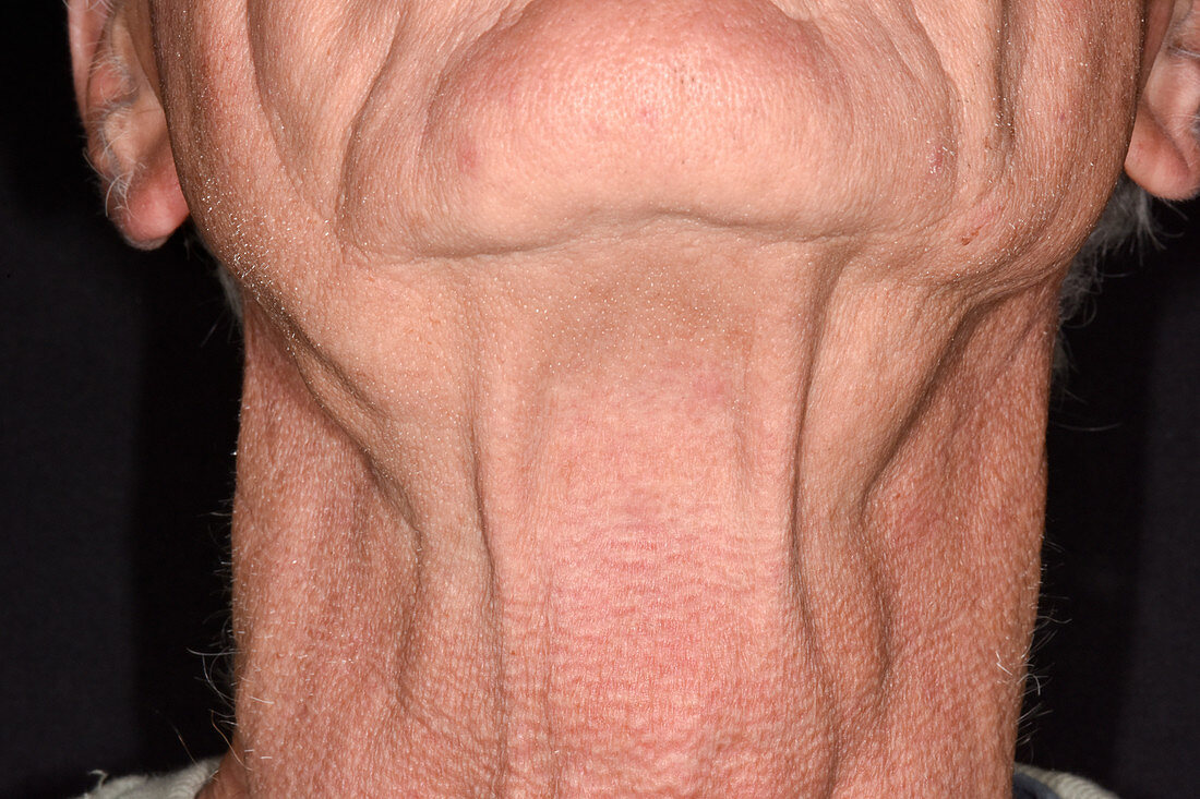 Swollen lymph glands