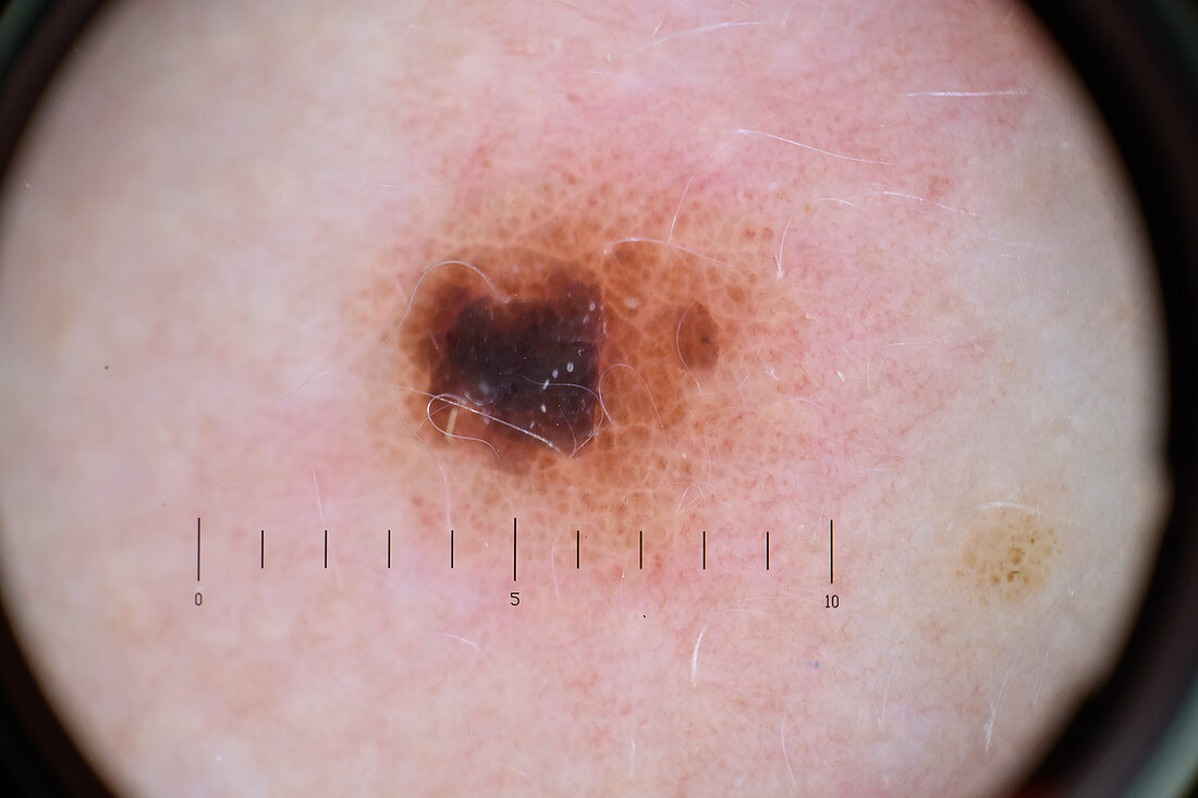 Mole, dermatoscope image