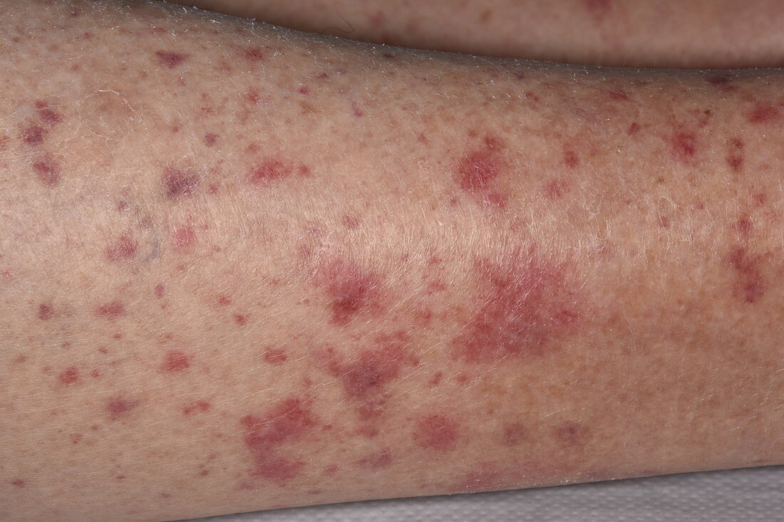 Allergic vasculitis