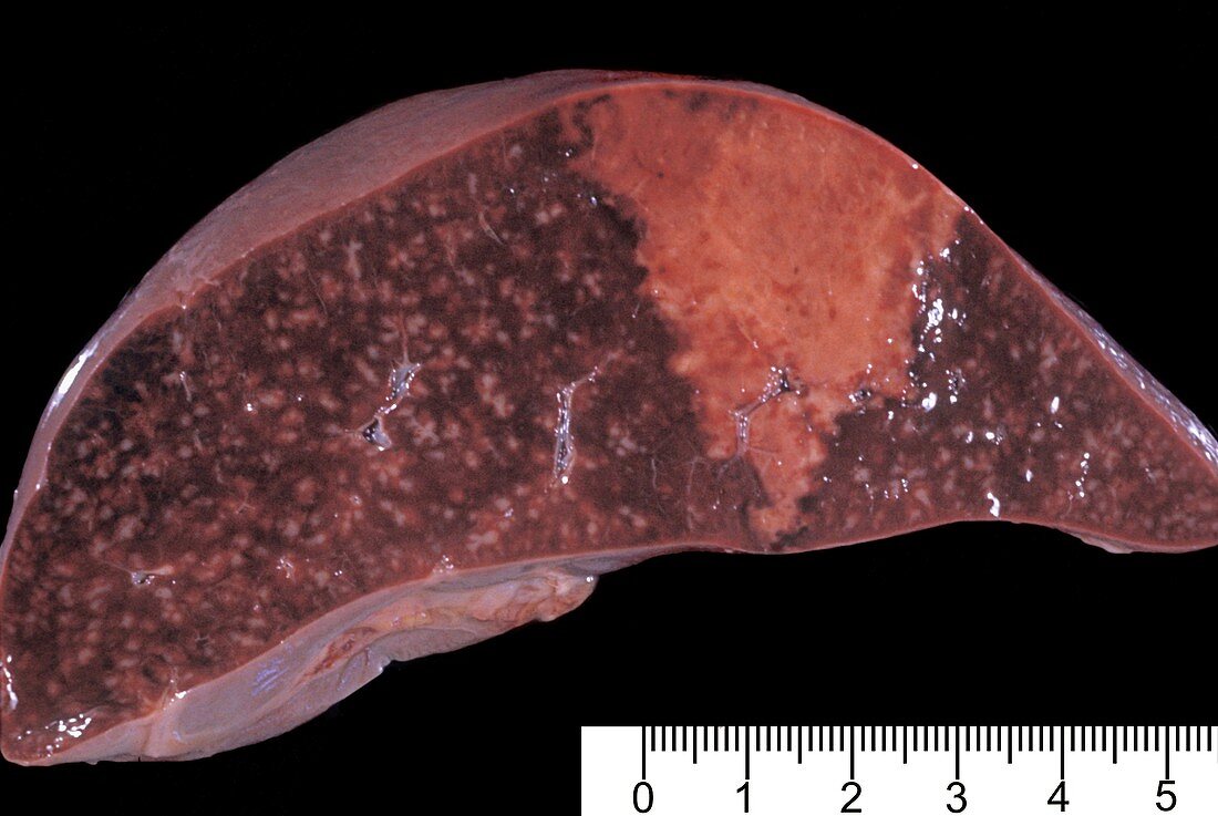 Anaemic infarct of the spleen